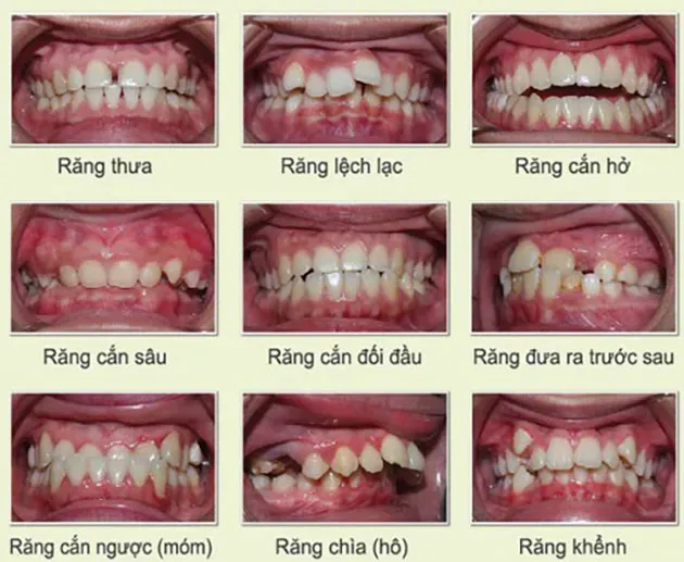 Răng Như Thế Nào Thì Nên Niềng? ⚡️ Người Lớn Nên Niềng Khi Nào?