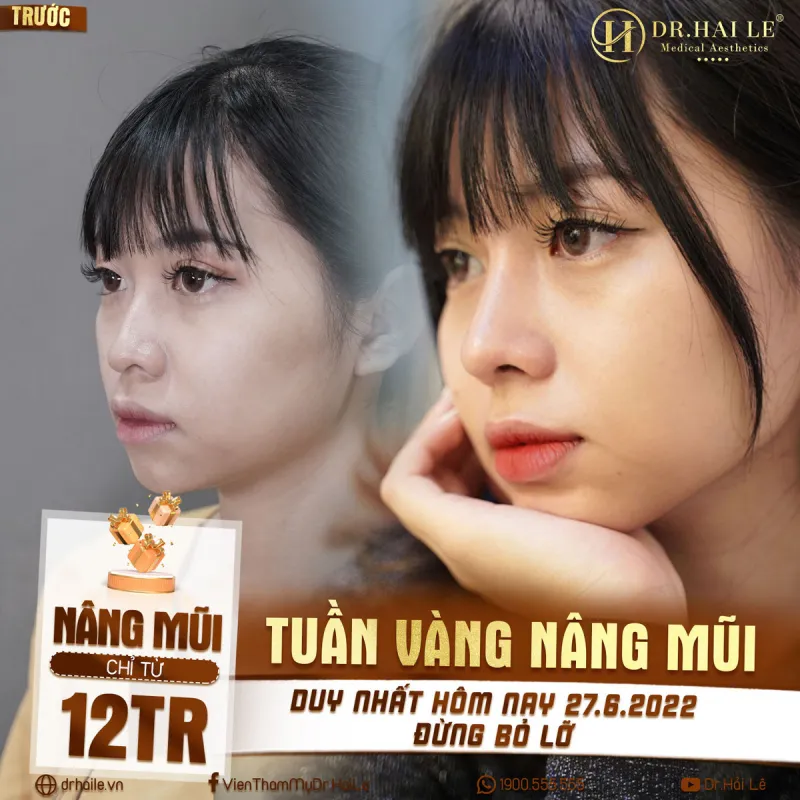 Top +10 Địa Chỉ Nâng Mũi Đẹp ở Hà Nội ⚡️ An Toàn & Uy Tín Nhất