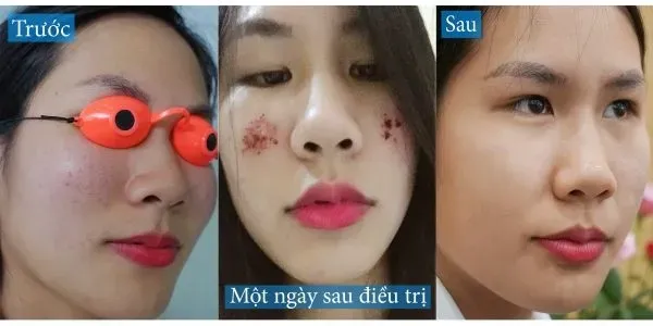 Top 10+ Địa Chỉ Trị Sẹo Uy Tín Tại Hà Nội Hiệu Quả & An Toàn Nhất