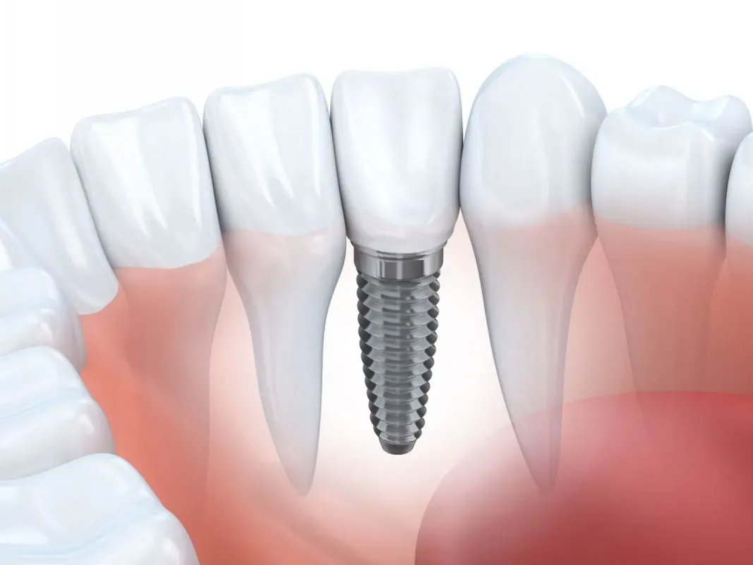 Top +10 Địa Chỉ Trồng Răng Implant Uy Tín TPHCM 【Kèm Báo Giá】